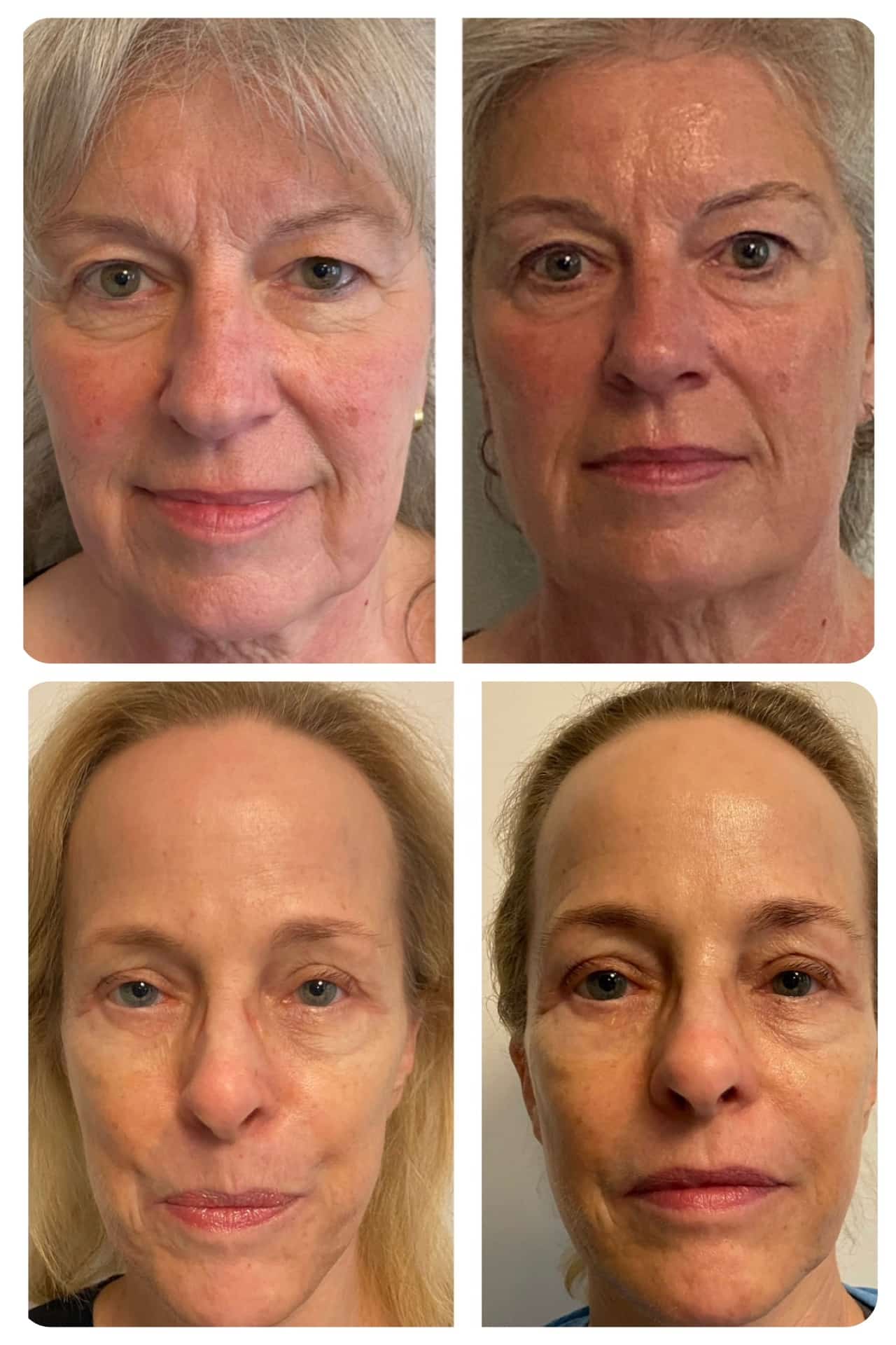 Mikrocurrents ansigtsbehandling hos Face and Body Balance i Charlottenlund og Holte