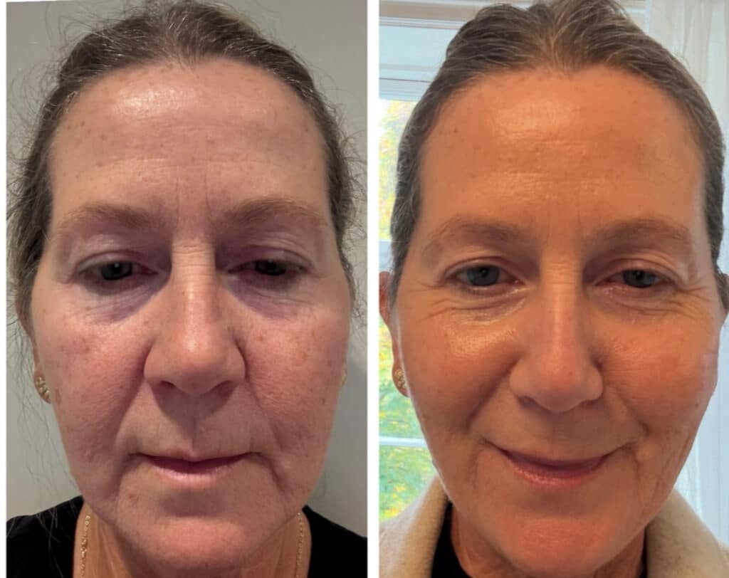 Resultat efter exosombehandling og LakseDNA hos Face and Body Balance